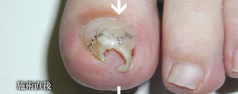 施術直後